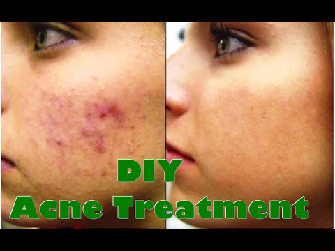 how to get rid of acne scars with vitamin e