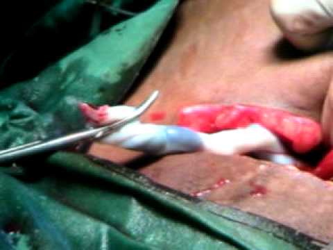 how to collect cord blood