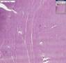 Histopathology Uterus--Leiomyoma