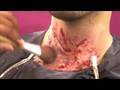 Chemical Burn Effect Final Destination