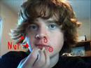 gilligen s acne