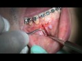 Lower anterior skeletal anchor placement, part 3, place anchor