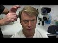 Bobman - Hair Transplant 2 Results - Hasson & Wong