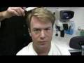 Bobman - Hair Transplant 2 Results - Hasson & Wong