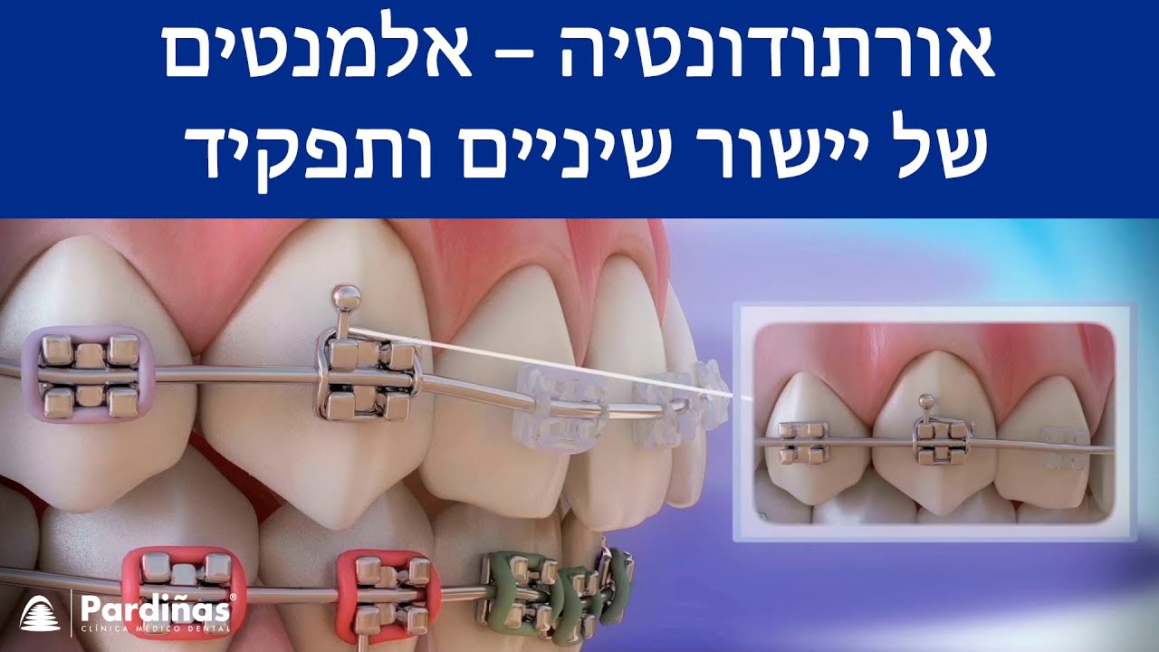 אורתודונטיה – אלמנטים של יישור שיניים ותפקיד ©