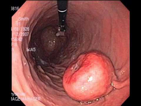 Exicion OfTthe GastrointestinaI Stromal Tumor Of The Proximal Stomach Using A Single Port Access Surgery