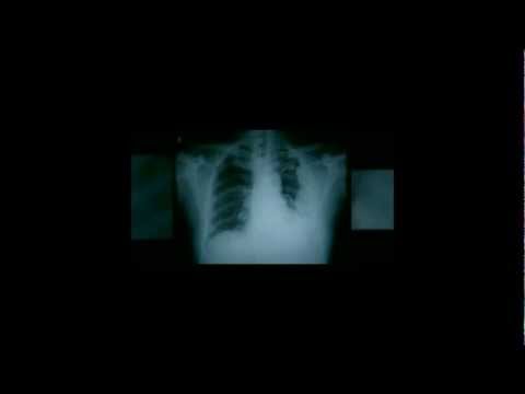 Louisiana Mesothelioma Lawyer – Your PH# Here? Choosing an Asbestos Cancer Lawsuit Attorney