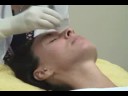 Sarasota Microdermabrasion - Microderm Aesthetic Treatment Sarasota Microdermabrasion - Microderm Aesthetic Treatment
