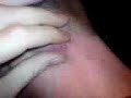 worlds biggest spot  zit