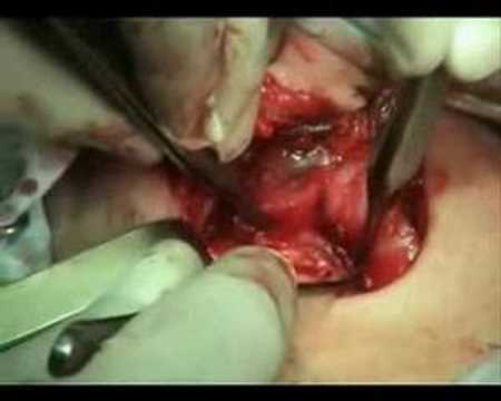 Total thyroidectomy with Dr. mahmud ...