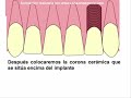Agenesia dental: Ortodoncia y sustituci�n con implan