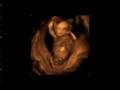 13 week ultrasound
