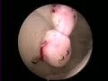 Neuroendoscopy course