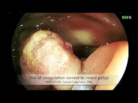 Wide Stalked Sigmoid Polyp