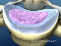 vertebra cervical e disco intervertebral