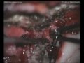 Olfactory grooves meningioma - Bifrontal approach