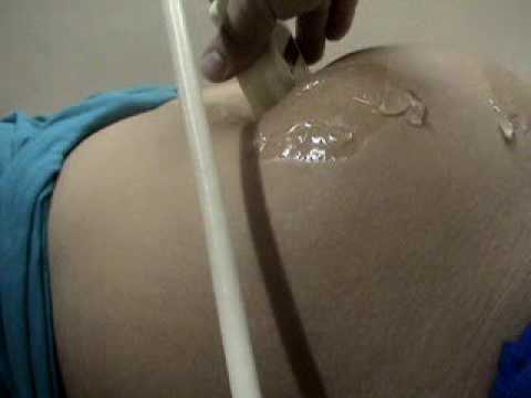 how to relieve rls during pregnancy
