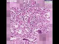 Histopathology Lung--Measles pneumonia