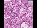 Histopathology Lung--Measles pneumonia