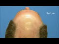 Hair Transplant Patient \"DT\" Before After - Hasson & Wong Hair Transplant Patient \"DT\" Before After - Hasson & Wong