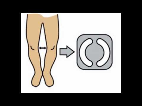 how to get rid knock knees