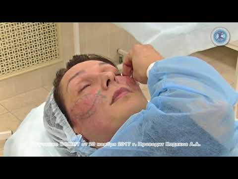 Установка нитей Soft Lift Comfort в щечно-скуловую область | ОСМНТ Установка нитей Soft Lift Comfort в щечно-скуловую область | ОСМНТ