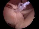 Traumatic biceps rupture