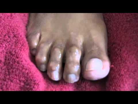 how to cure ugly feet