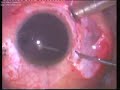 Eight Copper Wires Intraocular foreign bodies  Surgery  Dr. Ajay Dudani