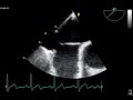 ATRIAL SEPTUM ANEURYSM / ANEVRYSME SEPTUM INTER ATRIAL