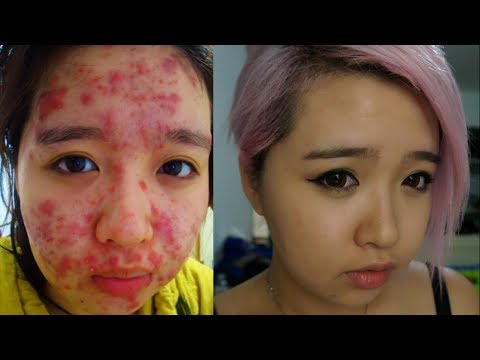 how to stop cystic acne