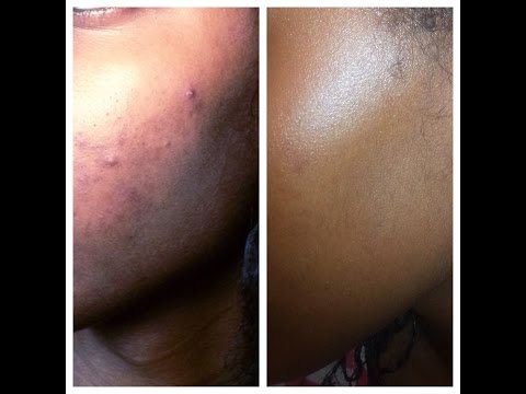 How I Faded My Dark Spots/Acne Marks