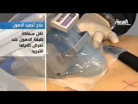 الشحوم - تجميد الدهون وسيلة رائجة لإزالة الشحوم ببريطانيا.
