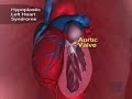 Tiny Hearts Get Fixed In Womb (CBS News)