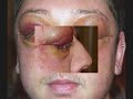 pats-orbital-decompression-surgery.html