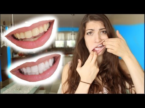 how to whiten stained teeth