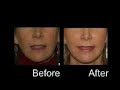 About Facial Volume: Fat Grafting Transfer, Injections, Implants
