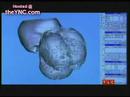 tumor in head
