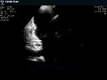 Ischemic Viable Inferior Wall and PVC Ischemic Viable Inferior Wall and PVC
