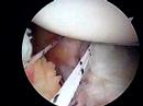 Arthroscopic Bankart Repair Arthroscopic Bankart Repair