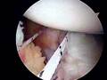 Arthroscopic Bankart Repair