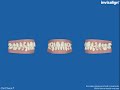 YouTube Video: This video details the movement created by Invisalign aligners YouTube Video: This video details the movement created by Invisalign aligners