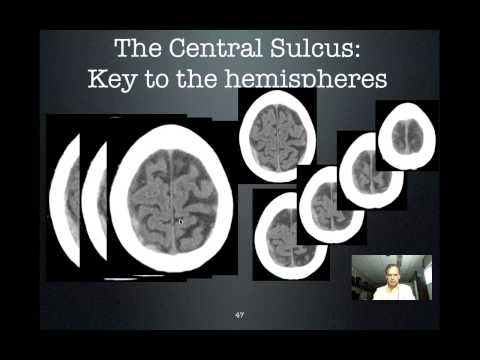 how to locate precentral gyrus
