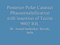 Posterior Polar Cataract Phaco Tecnis IOL Sudhalkar Eye Hosp