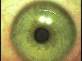 PRK, The Safest Laser Vision Correction Technique PRK, The Safest Laser Vision Correction Technique
