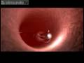 Un micromotor en las arterias
