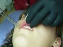 ACERO Y PIEL - aka-gum piercing frenillo labio superior