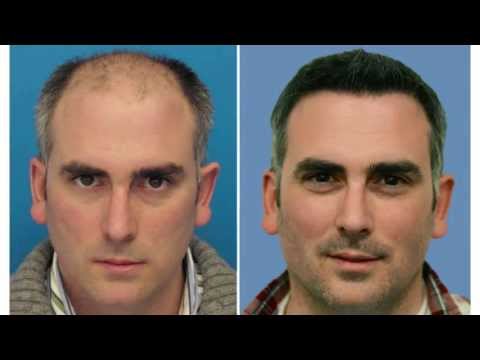 how to do hair transplant at home