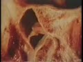 Pathology: Anterio Medial DDR