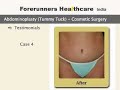 Tummy Tuck (Abdominoplasty)